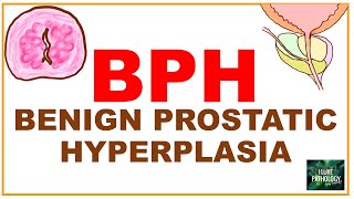 Benign Prostatic Hyperplasia  BPH etiopathogenssis Pathology amp clinical features [upl. by Yelrebmik]