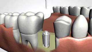 Dental Implants [upl. by Philine690]