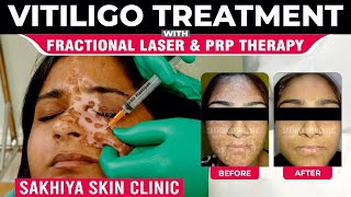 Vitiligo Treatment with Fractional Laser amp PRP Therapy  Sakhiya Skin Clinic [upl. by Swift]