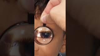 Fundoscopy with 20d lens and mobile camera  viralvideo eyelashes visions trendingshorts youtub [upl. by Lauraine]