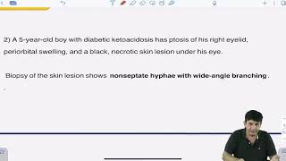 Case study  Mucormycosis [upl. by Drauode]