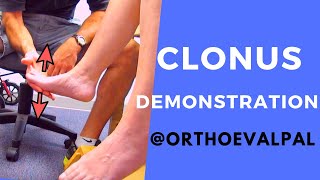 Clonus Demonstration with Ortho Eva Pal [upl. by Ayotnahs]