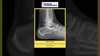 Radiology Case of the Day  Sept 3  Kinetic Radiology  Ankle Xray [upl. by Rosenfeld691]