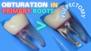 🟡Obturation in Primary Teeth Roots 🟢 Pulpectomy 🔵 [upl. by Avla]