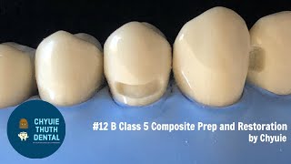 ChyuieThuth 12 B Class 5 Composite Prep and Restoration [upl. by Moynahan]