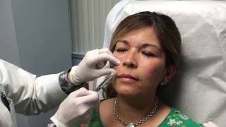 Juvederm Vollure Injection Treatment [upl. by Mosi514]