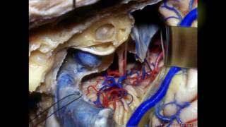 Navigating the Temporal Bone  Part 3 of 3 [upl. by Devad869]