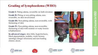 31Filariasis Clinical Features Diagnosis and Management [upl. by Nyrehtak255]