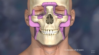 Mayo Clinic’s First Face Transplant The Surgery [upl. by Rekyr827]