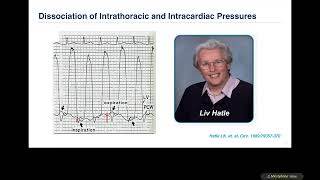 ASE 2021 Echo evaluation of Pericardial diseases Constrictive vs Restrictive [upl. by Nanni450]