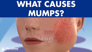 Mumps parotitis and other salivary glands conditions sialadenitis sialolithiasis mucocele © [upl. by Hills772]