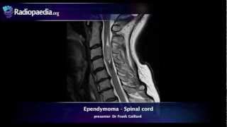 Spinal ependymoma  radiology video tutorial MRI [upl. by Zima50]