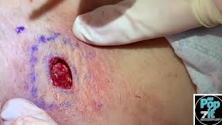 Ingrown hair armpit abscess Swollen firm nodule that felt like cyst drains cyst particles amp hair [upl. by Dale]