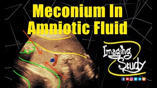 Meconium in Amniotic Fluid  Ultrasound  Case 314 [upl. by Eeloj]