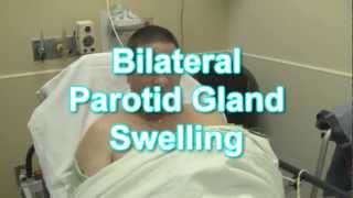 Bilateral Parotid Gland Swelling [upl. by Tigram64]