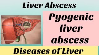 Liver Abscess pyogenic abscess with notes bamsfinalyear shalyatantra surgery bams4thyear bams [upl. by Casper]