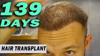 FUE Hair Transplant 139 Days post op Istanbul Turkey GROWTH STAGE [upl. by Nuli]