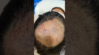 Crown Hair Transplant 8 Months Results hairtransplant shortvideo [upl. by Jarus]