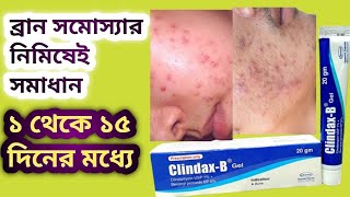 Clindax B Gel কি কাজ করে ব্রান সমস্যা নিমিষেই সমাধান How to Clindax B Gel [upl. by Drofyar217]