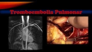 Tromboembolia pulmonar [upl. by Petersen445]