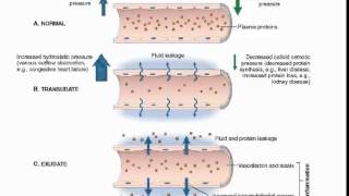 Exudate vs transudate [upl. by Hahnke859]