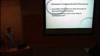 Chronic Conjuctival Chemosis [upl. by Norrahc746]