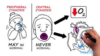 Hypoxia and Cyanosis How to react when oxygen levels are low [upl. by Aenea579]