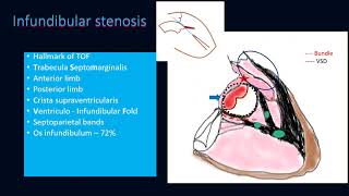 Tetralogy of Fallot [upl. by Laicram474]