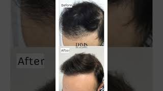 FUE HAIR TRANSPLANT BEFORE amp AFTER  DRMEDISPA [upl. by Olegna468]