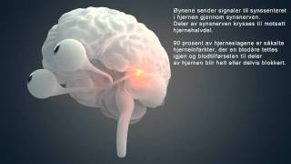 Synsutfall etter hjerneslag [upl. by Eletnahs]