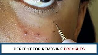 Laser Plasma Pen for Freckle Skin Tag Spot Mole Tattoo Removal  Ortorex [upl. by Mook]