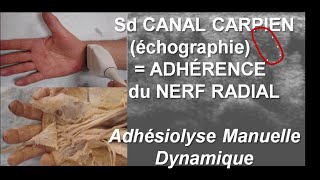 échographie Syndrome Canal Carpien  Adhérences Nerf Médian ostéopathie [upl. by Yddet]