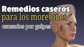 Remedios caseros para los moretones causados por golpes [upl. by Naynek306]