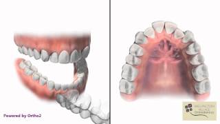 Clear Removable Aligners Invisalign  Wellington Village Orthodontics [upl. by Ainoz34]