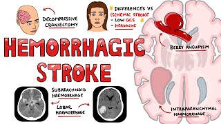 Hemorrhagic Stroke  Intracerebral Hemorrhage amp Subarachnoid Hemorrhage  Management [upl. by Olra670]