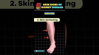 5 Weird Skin Signs of Kidney Disease  Chronic Kidney Disease shortsfeed kidney kidneydisease [upl. by Terraj772]