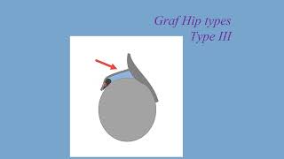 How to interpret the infant hip ultrasound [upl. by Ahsenod472]