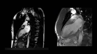 Normal versus athletes heart on cardiac MRI [upl. by Anaugal]