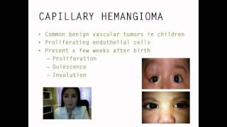 Periocular capillary hemangioma management  Video abstract 39029 [upl. by Karlin41]