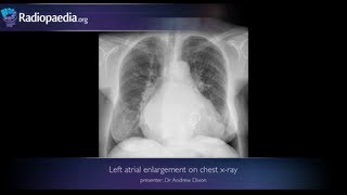 Left atrial enlargement on chest xray  radiology video tutorial [upl. by Nylcaj818]