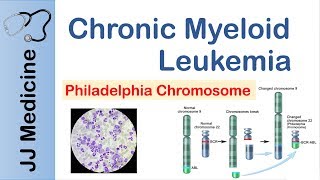 Chronic Myeloid Leukemia CML  Pathogenesis Symptoms and Treatment [upl. by Soelch]