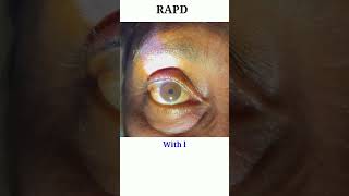 RAPD testing  Optic nerve test  Swinging flash light test eyecareoptom shorts rapd short eye [upl. by Nosredneh]