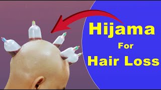 Does Hijama Therapy useful in Hair Loss  What is Hijama Therapy  बाल झड़ने में हिजामा थेरेपी [upl. by Natalina257]