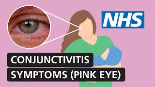 Conjunctivitis symptoms and treatment for red itchy watery eyes  NHS [upl. by Artenal40]