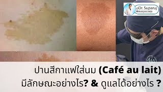 ปานสีกาแฟใส่นม Café au lait มีลักษณะอย่างไร amp ดูแลได้อย่างไร [upl. by Hali]