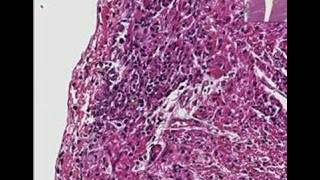 Histopathology Heart Coxsackie B2 myocarditis [upl. by Aihsercal]