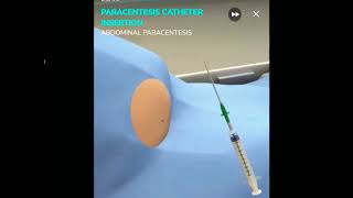 Paracentesis simulation [upl. by Toblat626]