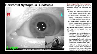 Nystagmus EXPLAINED 👀  Visualizing amp Interpretation [upl. by Otte822]