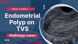 Endometrial Polyp on Transvaginal ultrasound  Radiology case 6 [upl. by Heman]