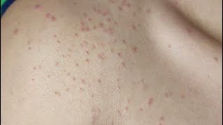 Folliculitis  រលាកគល់រោម [upl. by Qifahs]